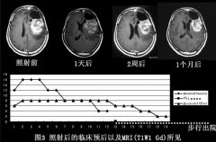 硼中子俘获治疗（BNCT）治疗恶性胶质瘤案例一则