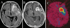 硼中子俘获法（BNCT）治疗恶性脑肿瘤的研究进展